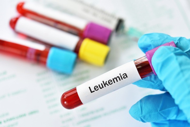 Leucemia mieloide acuta FLT3-ITD positiva di nuova diagnosi, arriva in Italia quizartinib