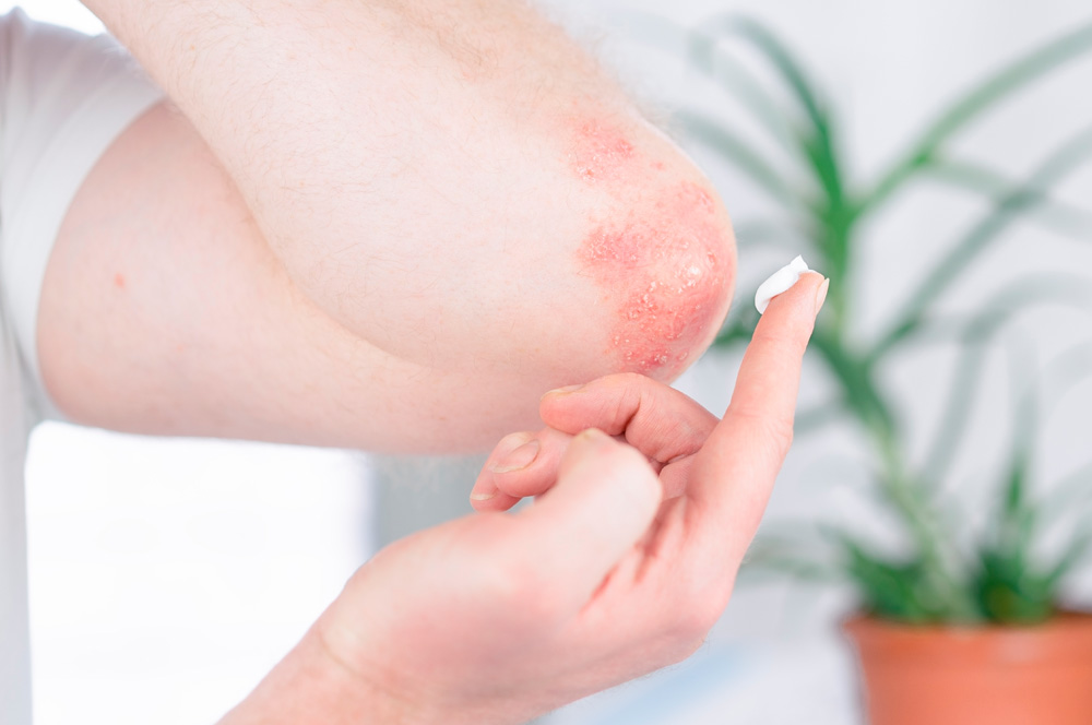 Dermatite atopica: i pazienti chiedono riconoscimento e tutele