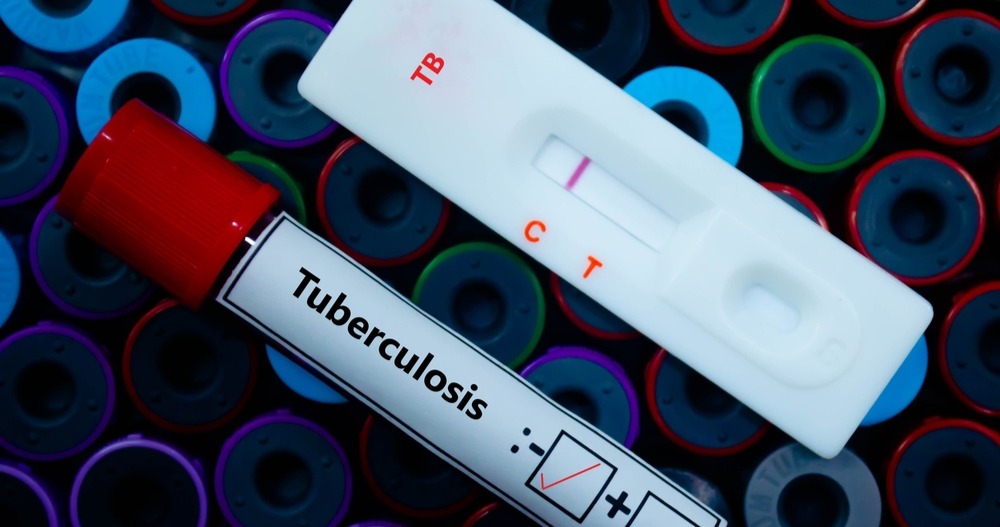 Tubercolosi. L’Oms lancia linee guida strategiche per combatterla