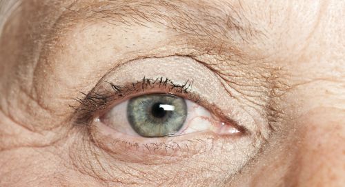 Salute visiva. Una persona su due che affronta cecità per cataratta ha bisogno di accedere a interventi chirurgici