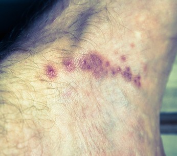 Scabbia, boom di casi e cure a carico dei pazienti: “Nessun farmaco è fornito gratuitamente dal SSN”