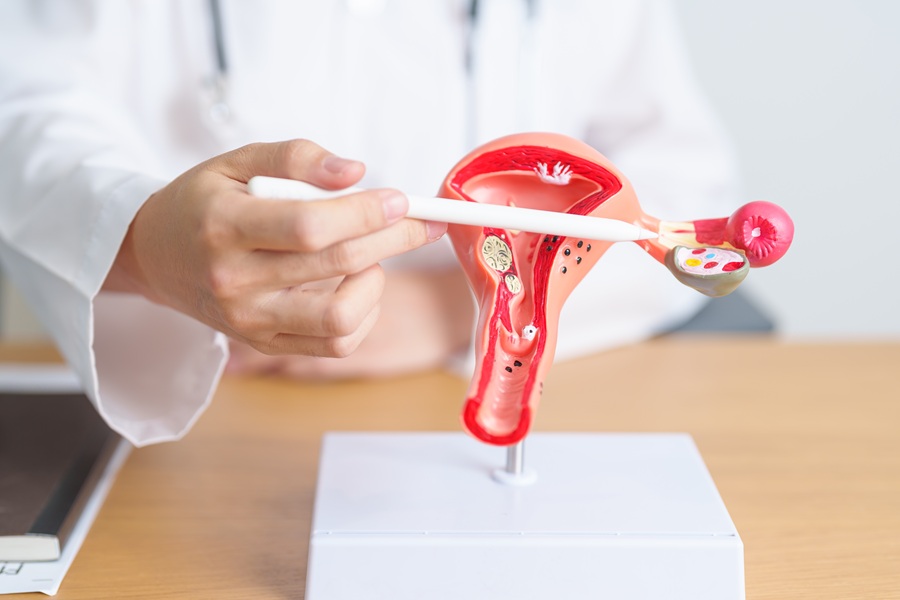 Una rimozione preventiva riduce il tumore ovarico dell’80%