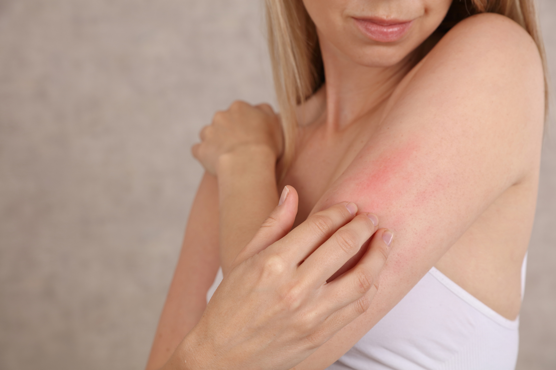 Orticaria Cronica Spontanea: la Commissione europea approva remibrutinib