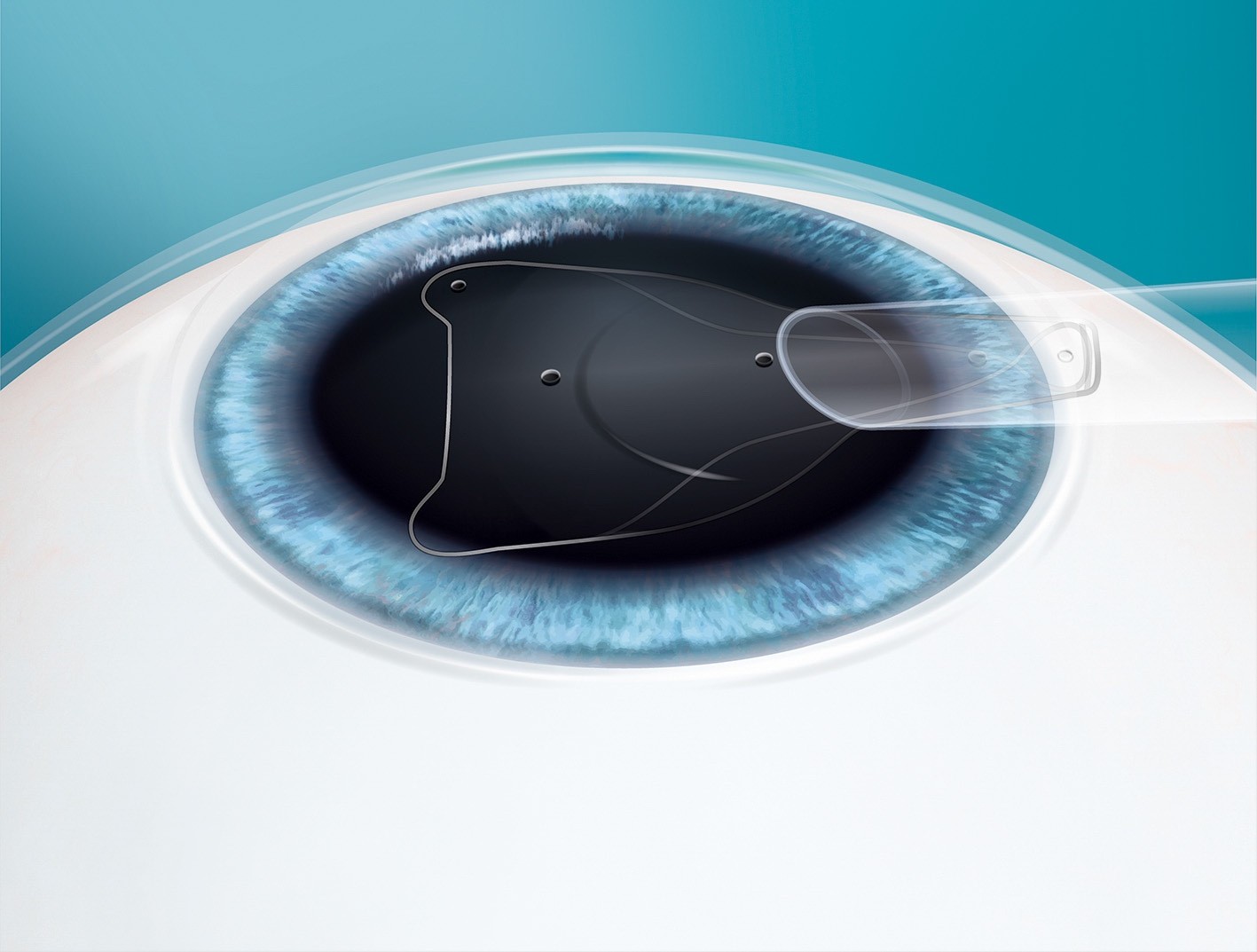 Cheratocono, nuove prospettive per migliorare la vista anche con le lenti ICL