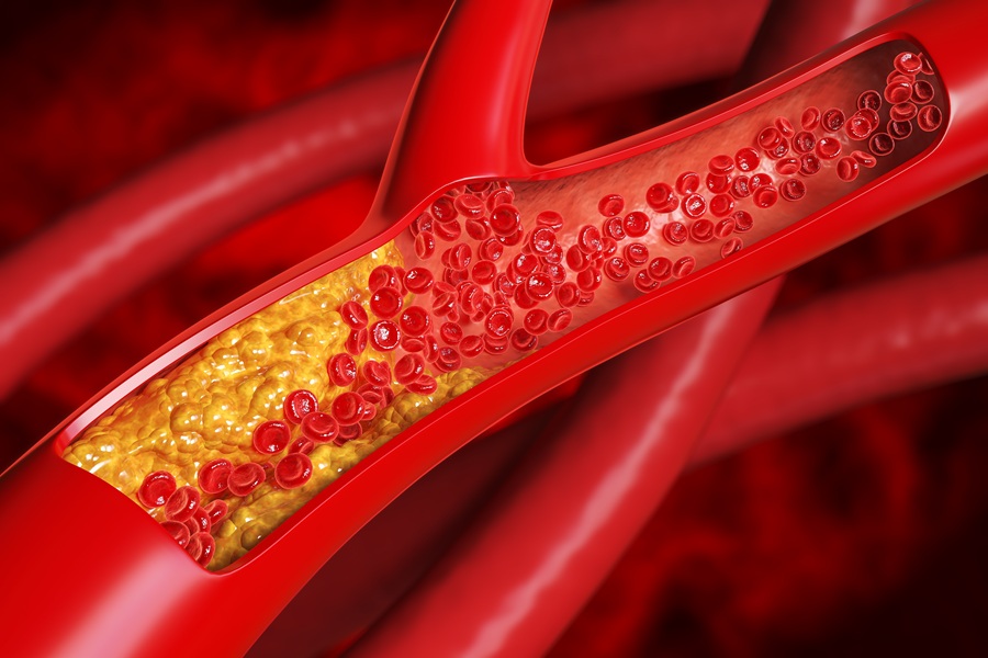Aterosclerosi, scoperto il sistema di autodifesa naturale dei vasi sanguigni